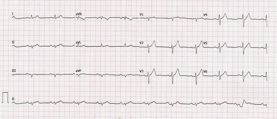 ECG 25.06.2020 cardiofamilia