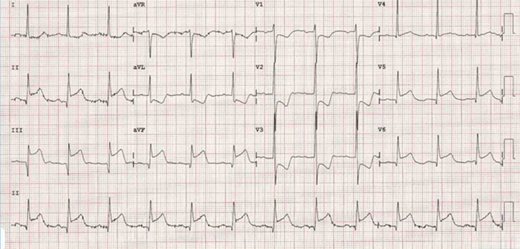 ECG marzo 2019 cardiofamilia
