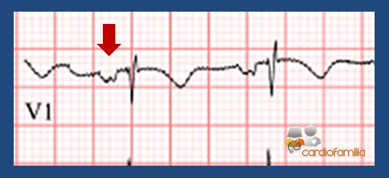 EM CAI CVD 1 2 cardiofamilia 1