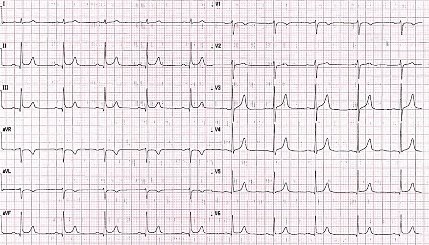 Diría Vd. que este ECG pertenece a...