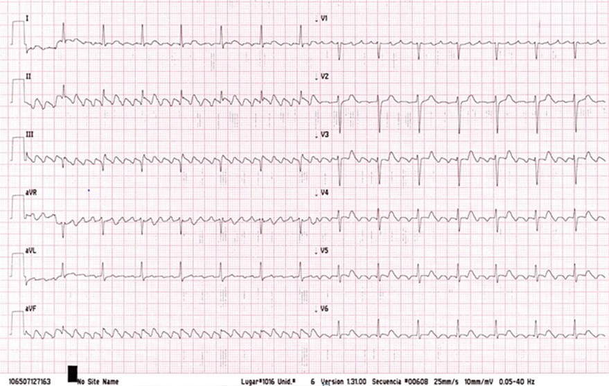 El siguiente ECG ha sido tomado a un varón de 47 años, asintomático, durante un reconocimiento de rutina. ¿Qué le parece?