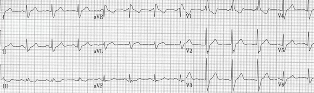 El ECG siguiente muestra un patrón muy típico de una anomalía. ¿Cuál?