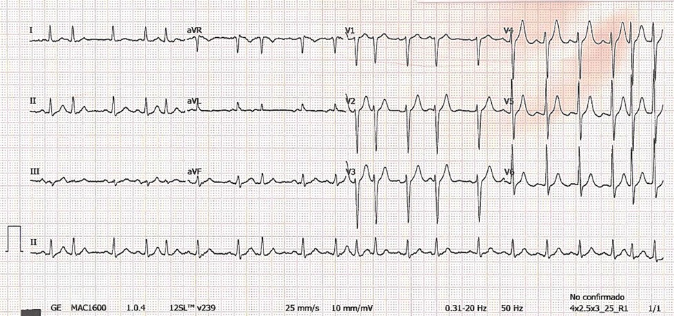 María, de 42 años, está muy preocupada porque tiene “palpitaciones”. Este es su ECG. ¿Qué le parece?