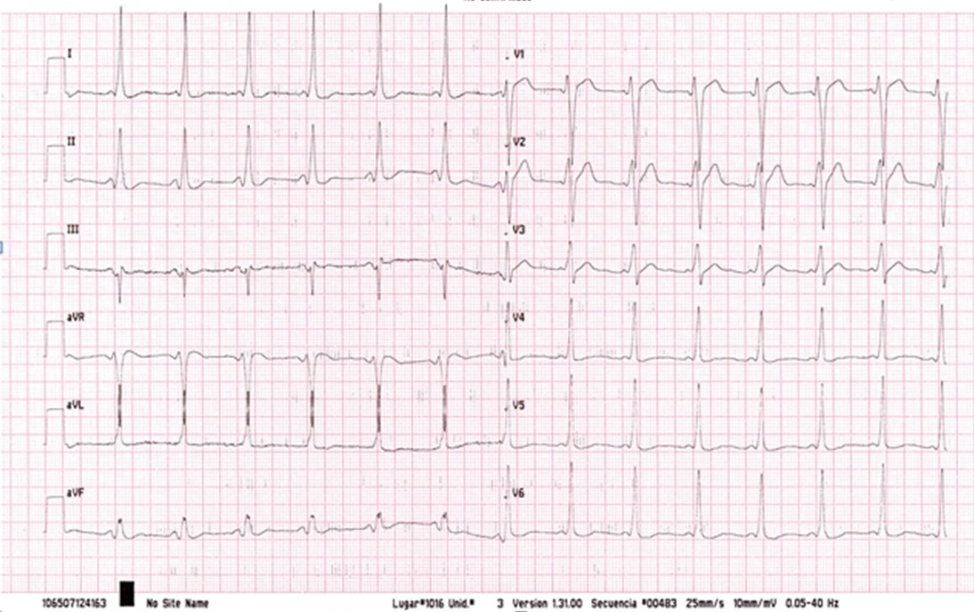 José, de 34 años, se queja de "palpitaciones" Vd. le pide un ECG, que se muestra a continuación, y piensa que