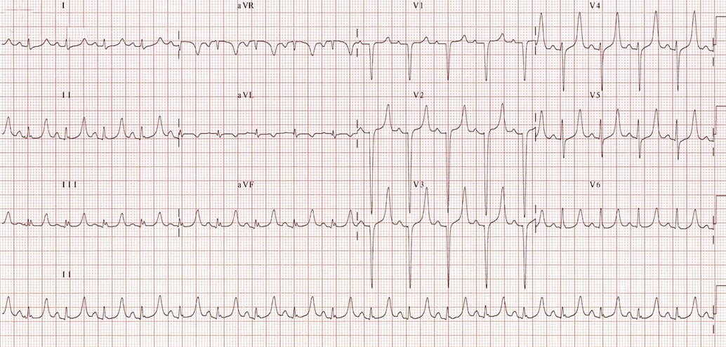 ¿Qué le parece el siguiente ECG?