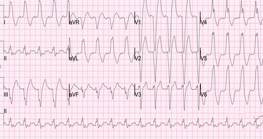 El ECG que se muestra a continuación fue registrado en Urgencias a un paciente que acudía en edema agudo de pulmón. ¿Qué le parece?
