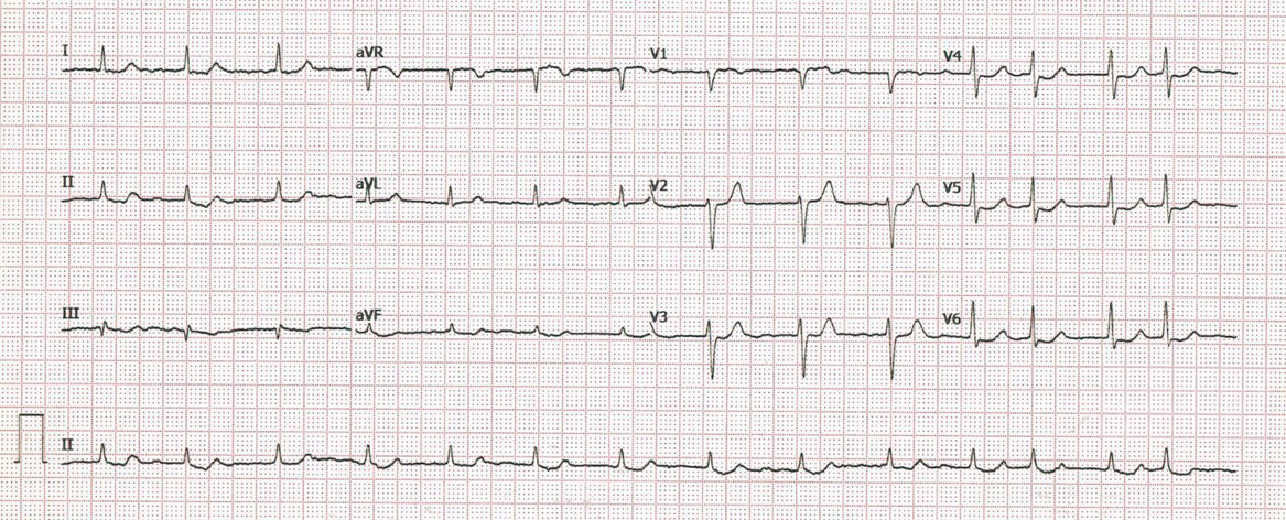 Analice el siguiente ECG, obtenido de un varón joven.