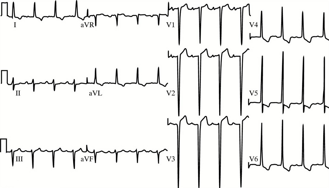 Este ECG corresponde a un paciente joven con coartación de la aorta no corregida. ¿Qué cree que muestra?