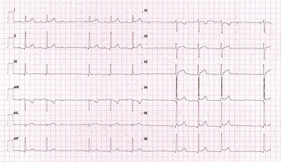 Paco, estudiante de Medicina y componente del equipo de balonmano, se hace un ECG que se muestra a continuación. Su consejo es que...