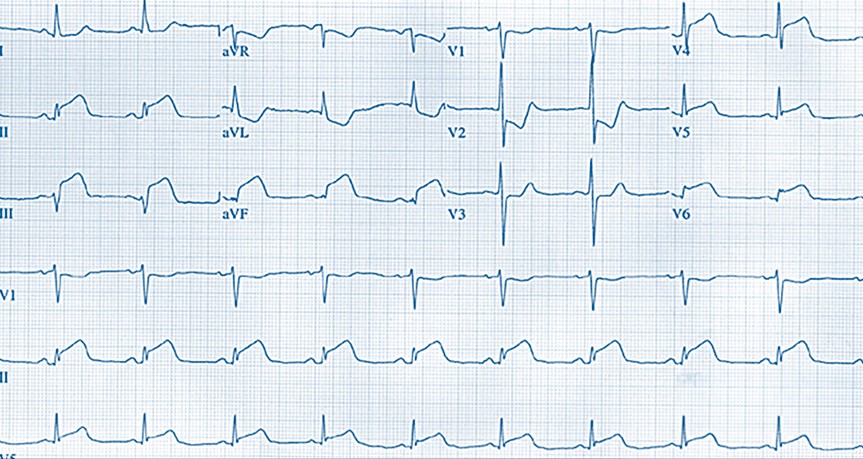 Paciente de 72 años que acude a Urgencias quejándose de indigestión. ¿Qué le parece el ECG?