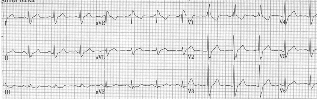El siguiente ECG corresponde a una mujer de 40 años que acude a consulta porque nota una sensación de pinchazos en el pecho, de segundos de duración, y que se relacionan con situaciones de estrés. Vd. le dice: