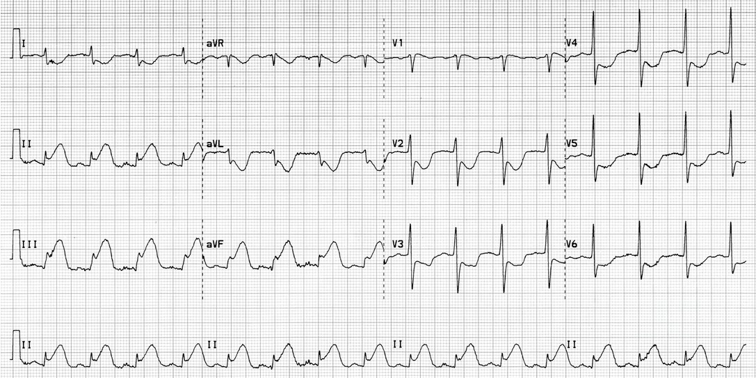 A la vista del ECG de este paciente, con dolor torácico, lo mejor es