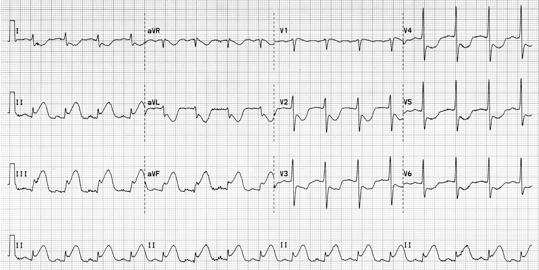 A la vista del ECG de este paciente, con dolor torácico, lo mejor es