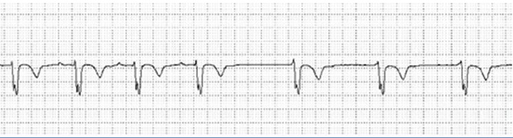 A la vista de esta tira de ECG de María Angustias, de 81 años, que se queja de perdidas de conocimiento, Vd cree que