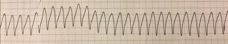 Juan de 67 años, que hace años sufrió un infarto de miocardio, acude a urgencias con el siguiente trazado. ¿Qué indica el ECG?