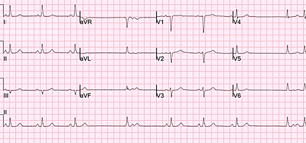 Un paciente de 72 años acude a consulta quejándose de episodios de mareo y pérdida de conocimiento. El ECG que Vd. le realiza en reposo muestra lo siguiente: