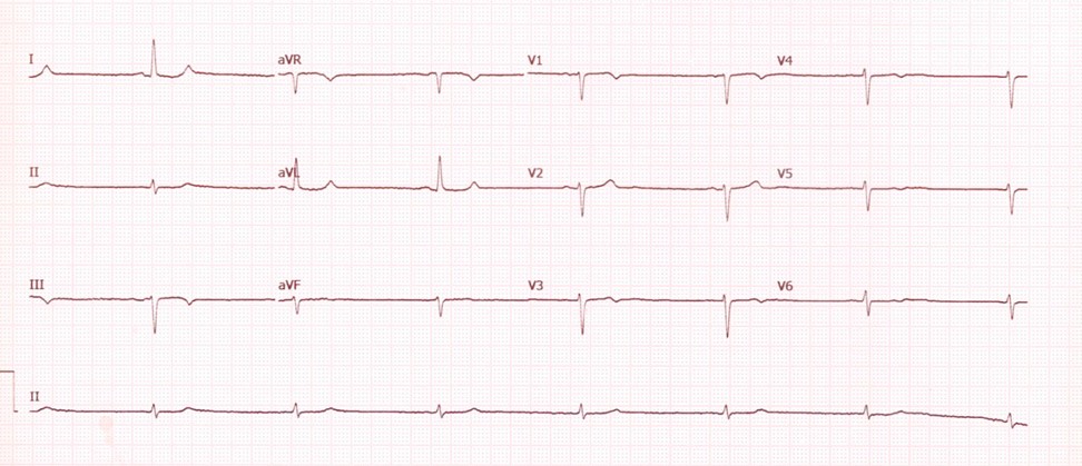 ¿Qué fármaco cree que es más probable que esté tomando el paciente al que pertenece este ECG?