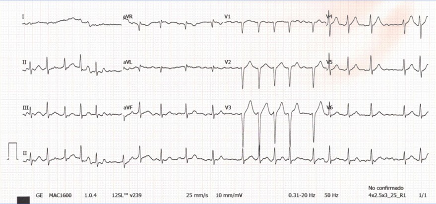 Una paciente con estenosis mitral moderada, previamente asintomática y en tratamiento con dosis bajas de diuréticos, ingresa de urgencias por cuadro de insuficiencia cardiaca franca. El ECG es el que se muestra a continuación. Vd. Cree que...