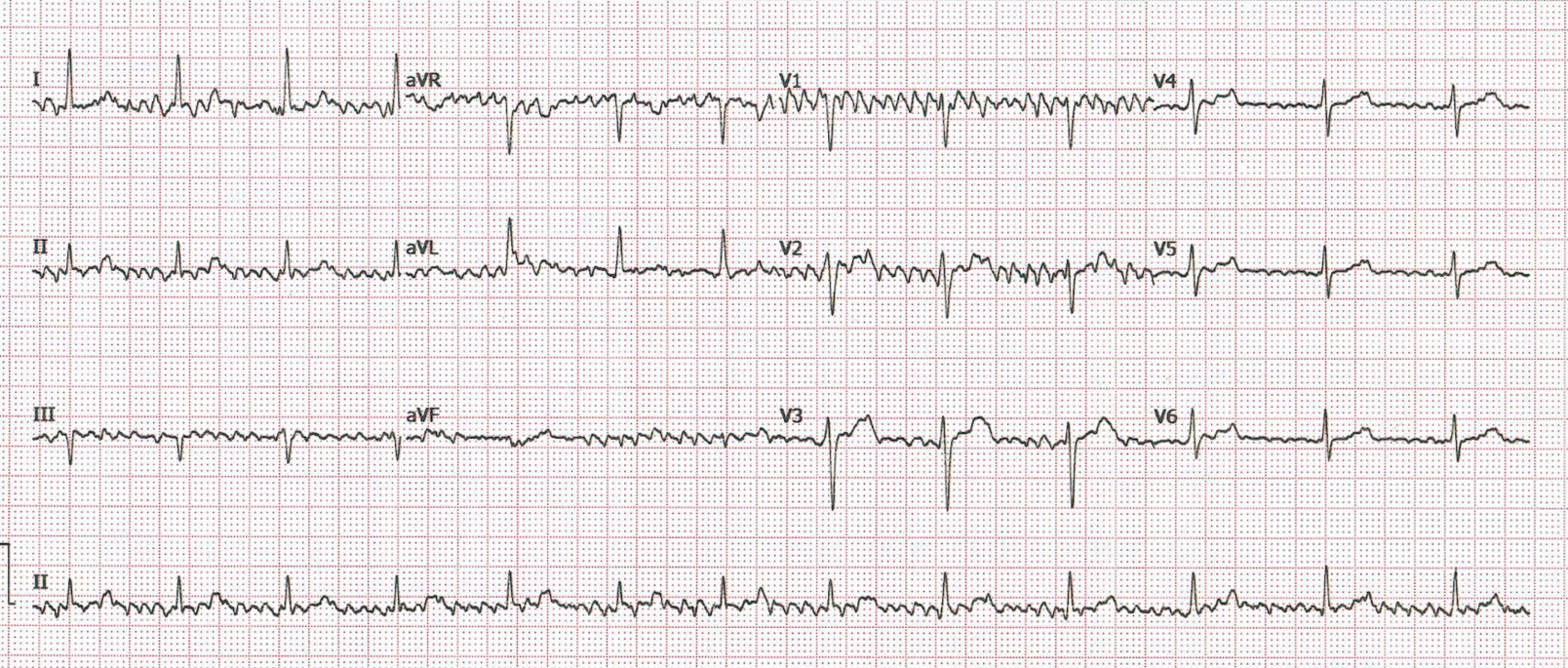 A la vista del ECG, ¿cuál es su diagnóstico?