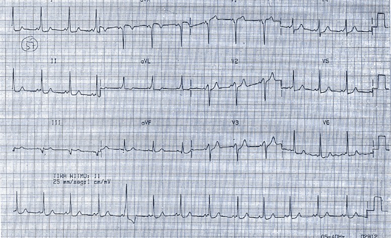 Mujer de 32 años que se queja de cuadros recortados de palpitaciones. A la vista del ECG, ¿cree que puede aventurar a qué se deben los síntomas de esta enferma?