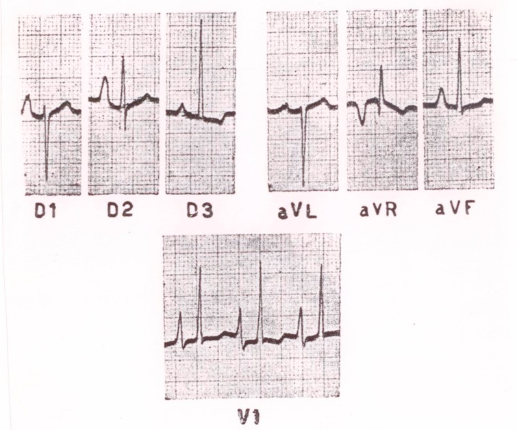 El niño al que pertenece el siguiente ECG presenta un soplo sistólico eyectivo. Lo más probable es que sea debido a: